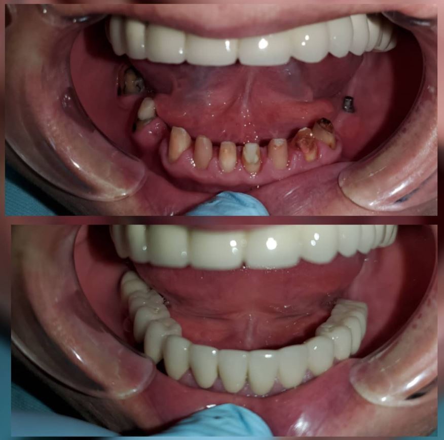 Лечение зубов Бишкек